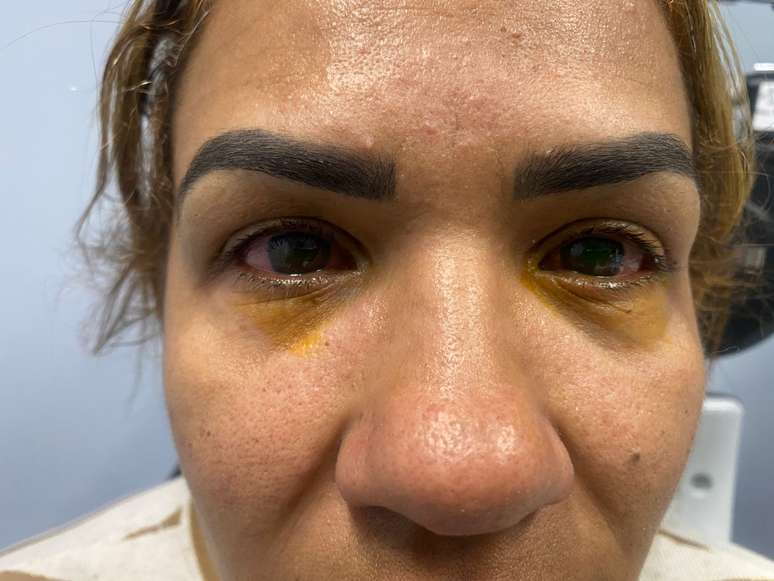 Lidiane afirma ter ficado com as c&oacute;rneas queimadas ap&oacute;s uso do Wedrop