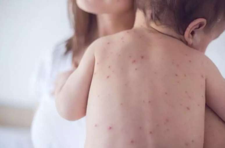 Morbillo: see symptoms, differences for chickenpox and if it is possible to infect more than once