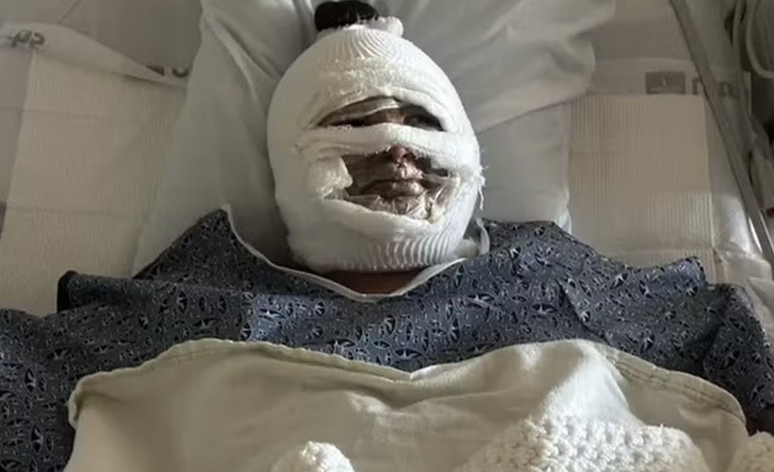 The young man suffers from burns on his face after the alcohol fireplace explodes during the field
