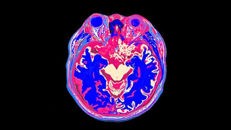 Uma varredura cerebral mostrando v&aacute;rias cores em diferentes partes do c&eacute;rebro