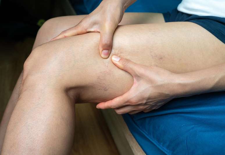 Trombose na perna: o que é, sintomas, causas e tratamento