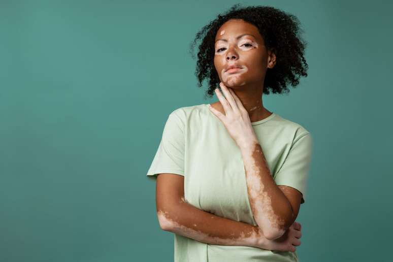 O vitiligo é caracterizado por áreas despigmentadas na pele