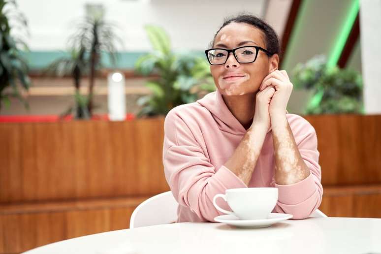 Não há formas cientificamente comprovadas de evitar o vitiligo 