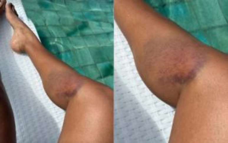 Hematomas de Sheron Menezzes