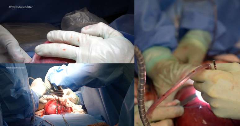 O programa mostrou imagens impactantes de cirurgia no útero exposto de uma gestante