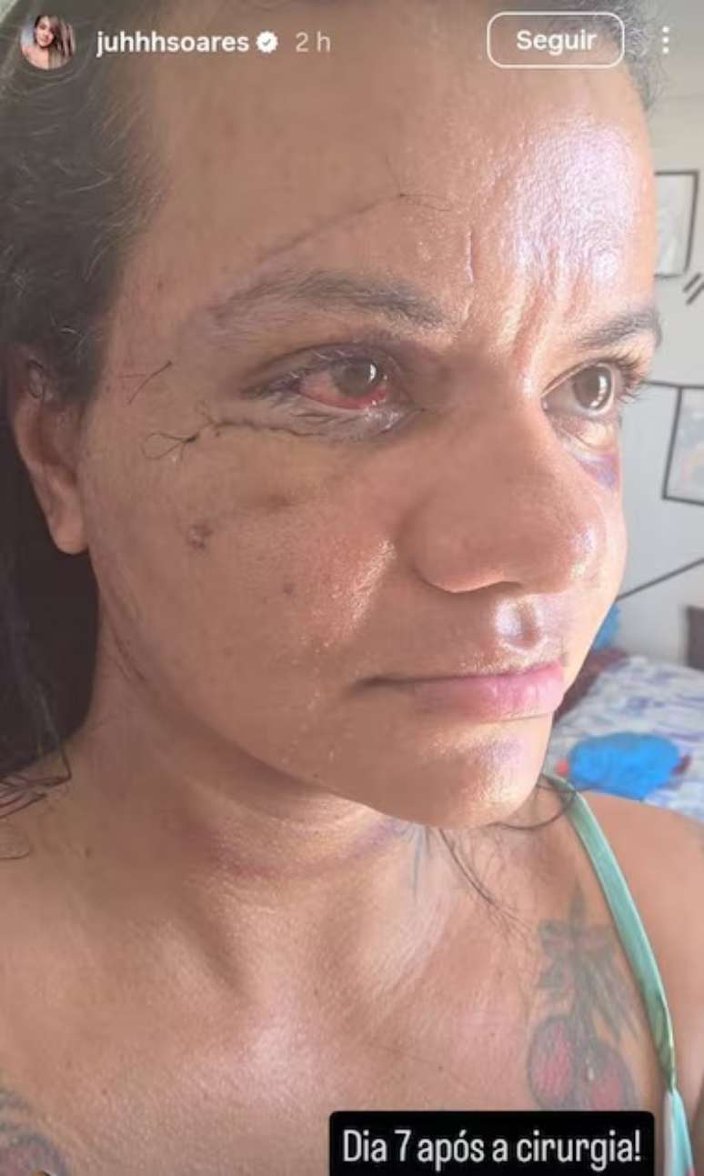 Rosto de Juliana Soares ap&oacute;s passar por cirurgia&nbsp;