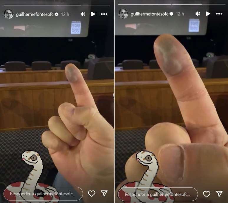 Guilherme Fontes revela como está seu dedo após ser picado por cobra - Reprodução/Instagram