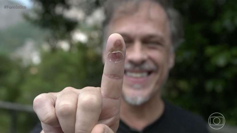 Guilherme Fontes mostra o dedo após picada de cobra -