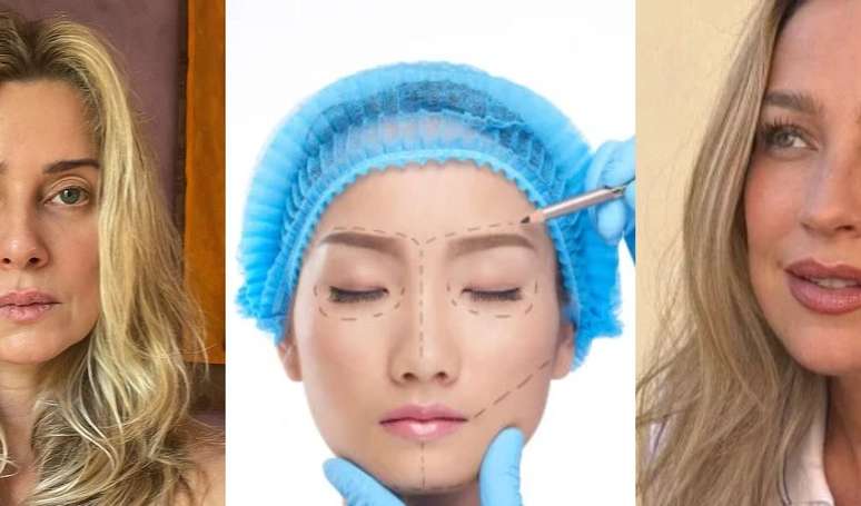 Nem silicone, nem lipo HD: Brasil é TOP1 do ranking mundial de cirurgia plástica feita por Luana Piovani, Letícia Spiller e mais famosas.