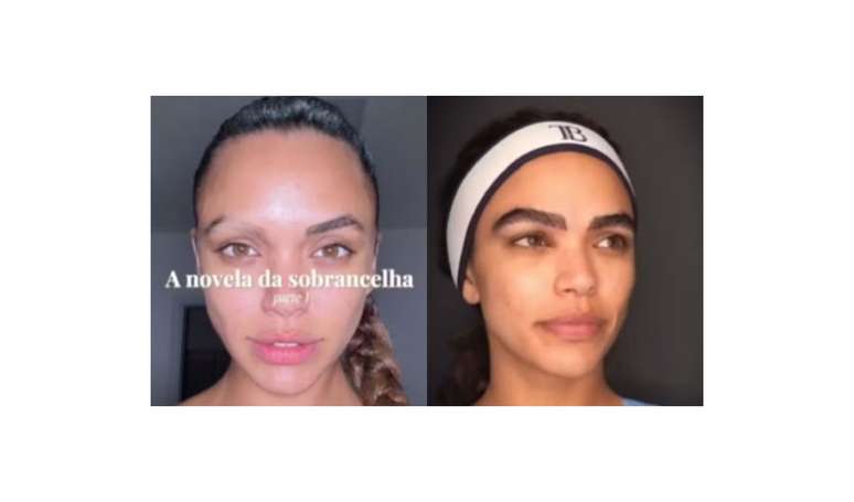 Baldness on the eyebrow: Giovana Cordeiro, of “Dona de me”, reveals an unusual diagnosis for the use of much chemistry in the hair; Dermatologist explains
