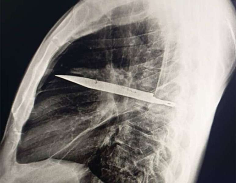 Homem não se queixou de dores, febre ou dificuldade para respirar