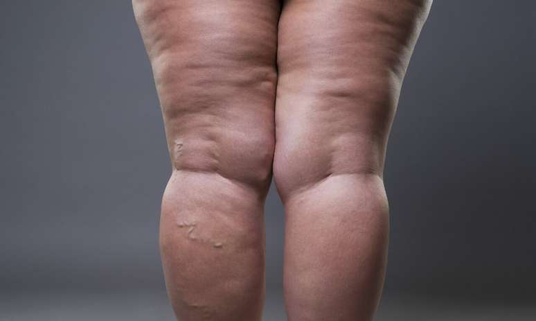 Is it really Lipedema? Ask your questions here Is it really Lipedema? Ask your questions here