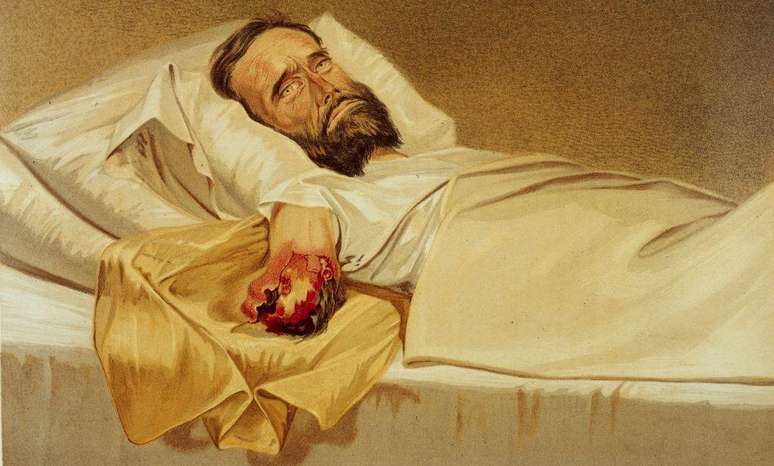 Soldado da Guerra Civil americana com uma infec&ccedil;&atilde;o hospitalar grave no bra&ccedil;o