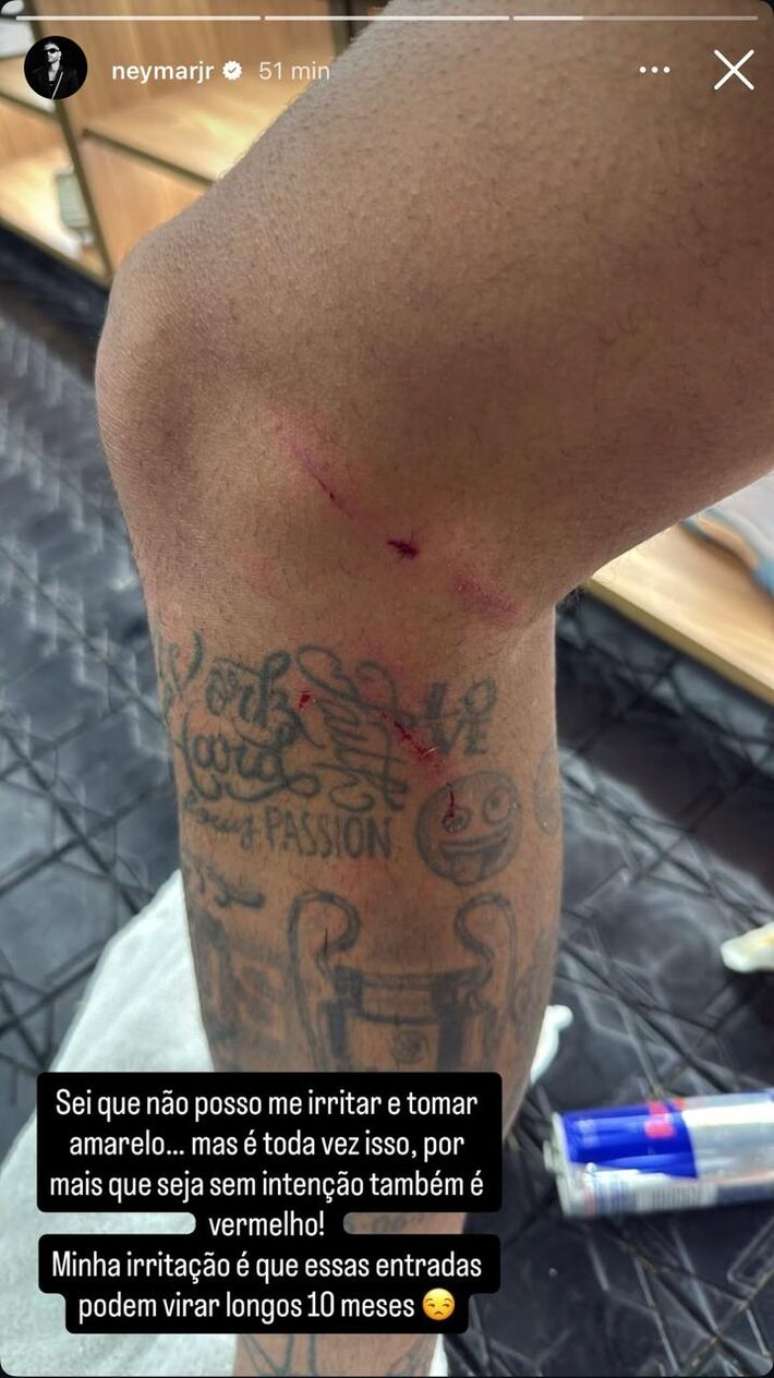 Neymar posta foto da perna machucada após duelo com o Fluminense.