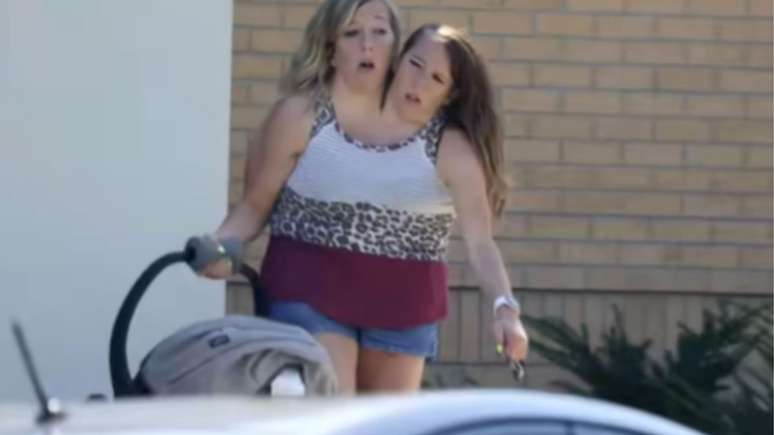 Siamese twins are seen with the newborn and raise doubts