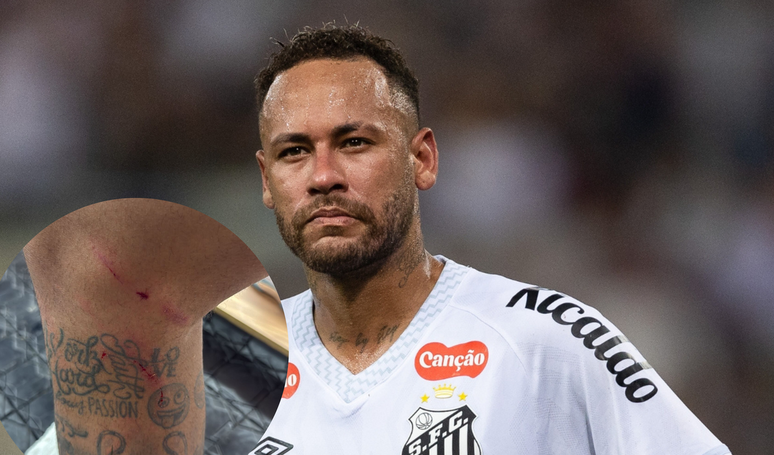 Neymar exhibits the injuries after the Santos game and raise debates on new serious injuries: “They can become 10 months long”