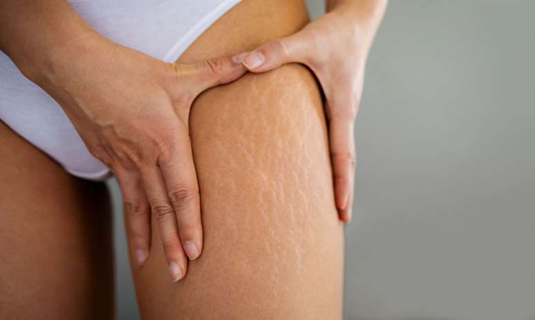 Stretch marks: see how they present themselves and how to treat Stretch marks: see how they present themselves and how to treat