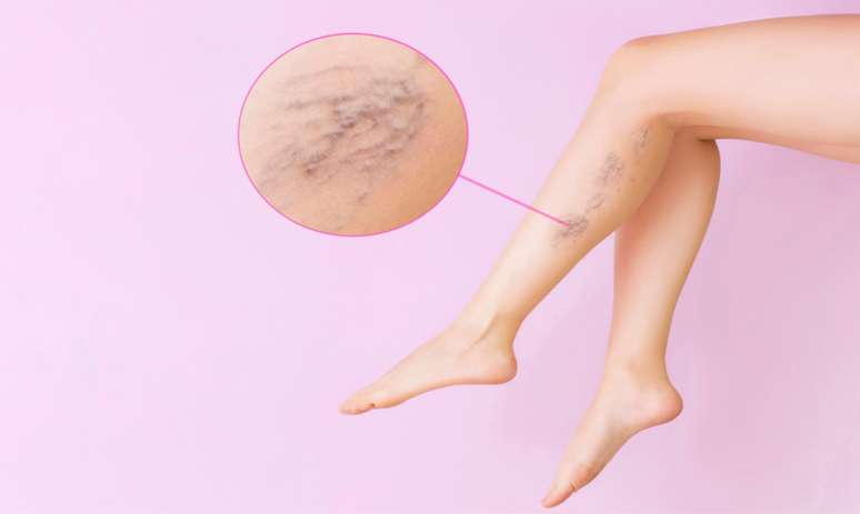 Varicose veins in adolescence: medical notice on symptoms and how to prevent
