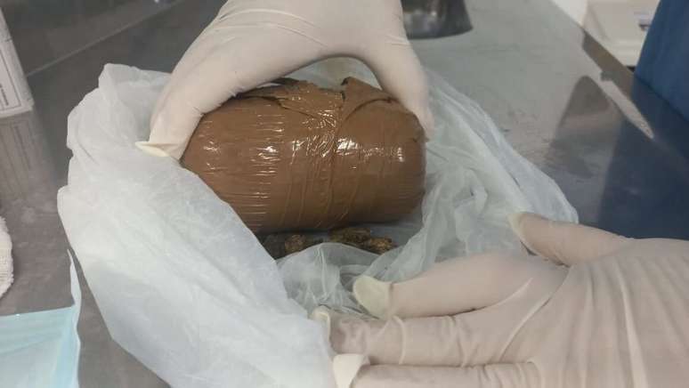 Gestante precisou passar por uma cirurgia para retirada da droga