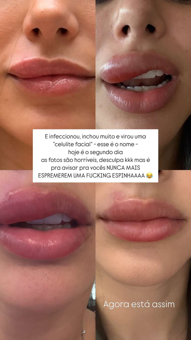 Bruna Biancardi shows the swollen lip from facial cellulite Bruna Biancardi shows the swollen lip from facial cellulite