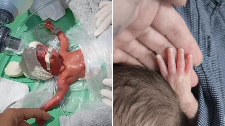 Henrique, currently 10 months, is considered a true miracle of Heusiléia Coelho
