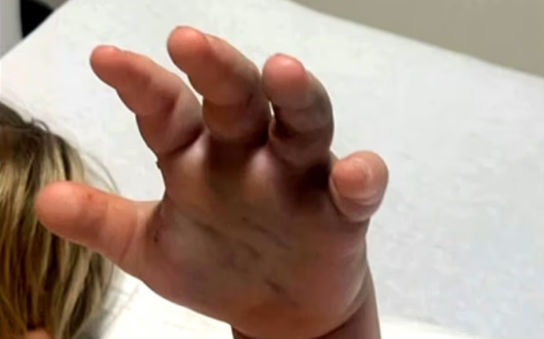 The child is hit by the snake in a nursery; And parents accuse the school of not calling the emergency