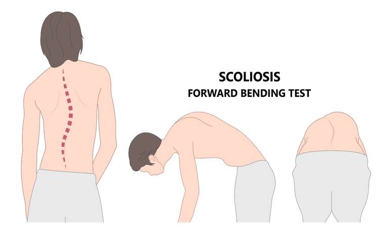 Scoliosis in children and teenagers: see how to identify the first signs