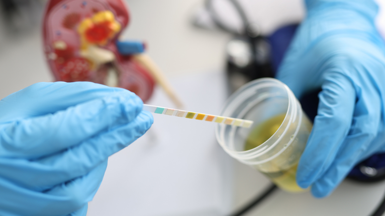 Pesquisadores apontam que o novo teste para câncer de próstata pode fornecer diagnósticos mais precisos e reduzir a necessidade de biópsias