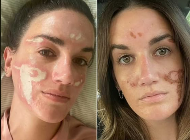 The customer accuses a beautician celebrity of causing burns on his face after peeling