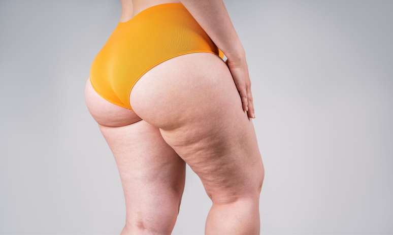 Cellulite: knowing types, causes and treatments