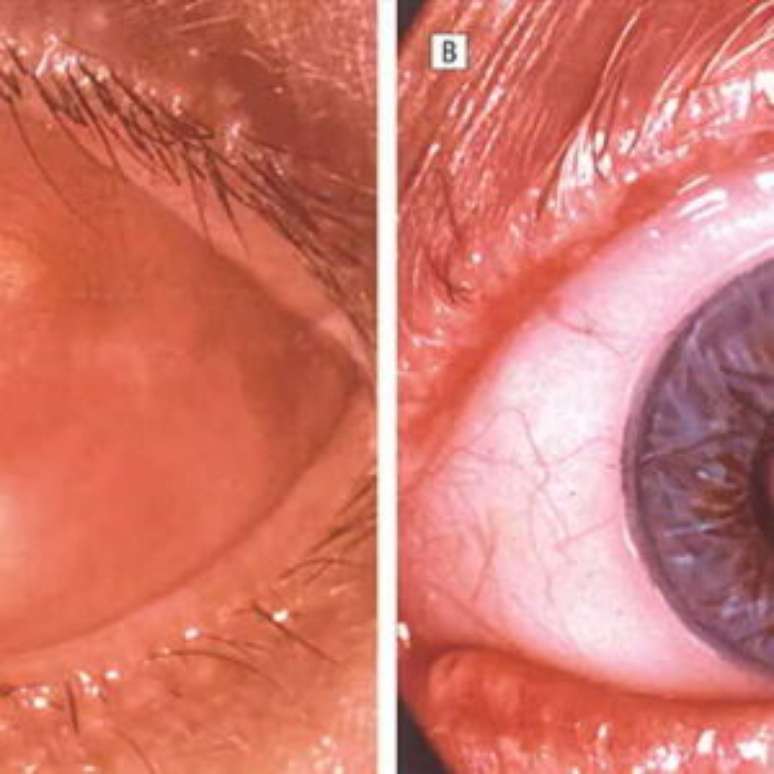 A esquerda coberto com a mucosa avermelhada do interior da boca, e com um pequeno círculo para a passagem da luz, a direita com a prótese para efeitos estéticos.