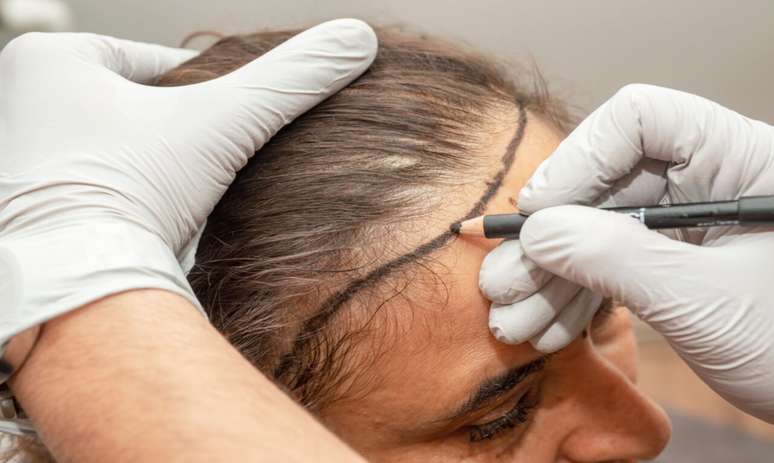 Women’s hair transplant: learn when and how to do
