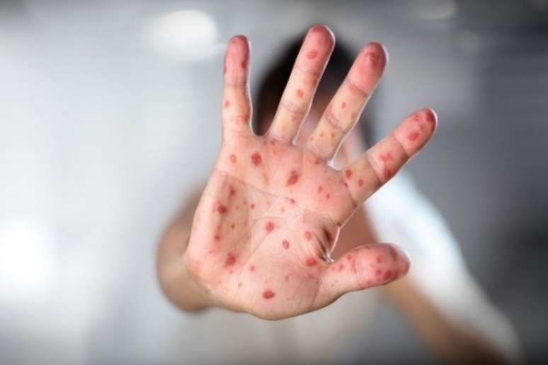 A doença mão-pé-boca (DMPB) é uma infecção viral comum em todo o mundo, causada principalmente pelo vírus Coxsackie A16