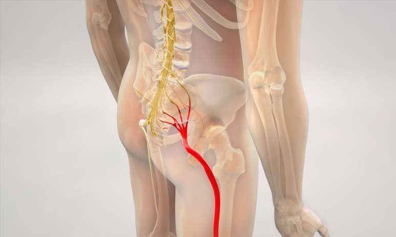 SIACTICAL PAIN: see what it causes and how to treat the problem