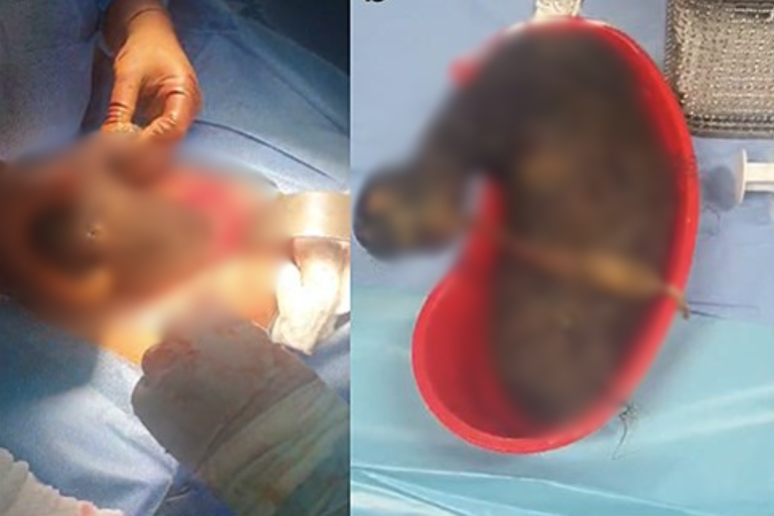 Teenager with “Rapunzel Syndrome” has a giant ball of hair removed from the stomach