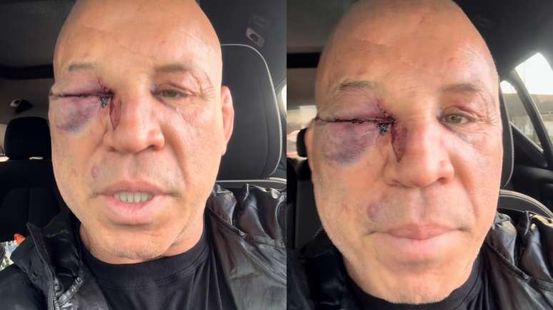 Wanderlei Silva precisou ser levado ao hospital após ser atingido durante a confusão generalizada que marcou o fim da luta principal do Spaten Fight Night, em São Paulo, com Popó Wanderlei Silva precisou ser levado ao hospital após ser atingido durante a confusão generalizada que marcou o fim da luta principal do Spaten Fight Night, em São Paulo, com Popó