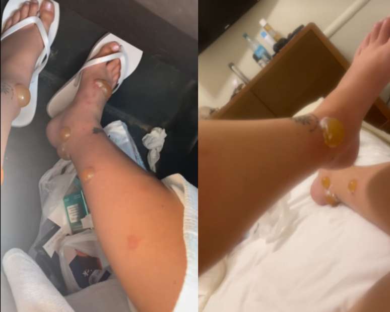 American has pus bubbles after being cut by honeymoon mosquitoes
