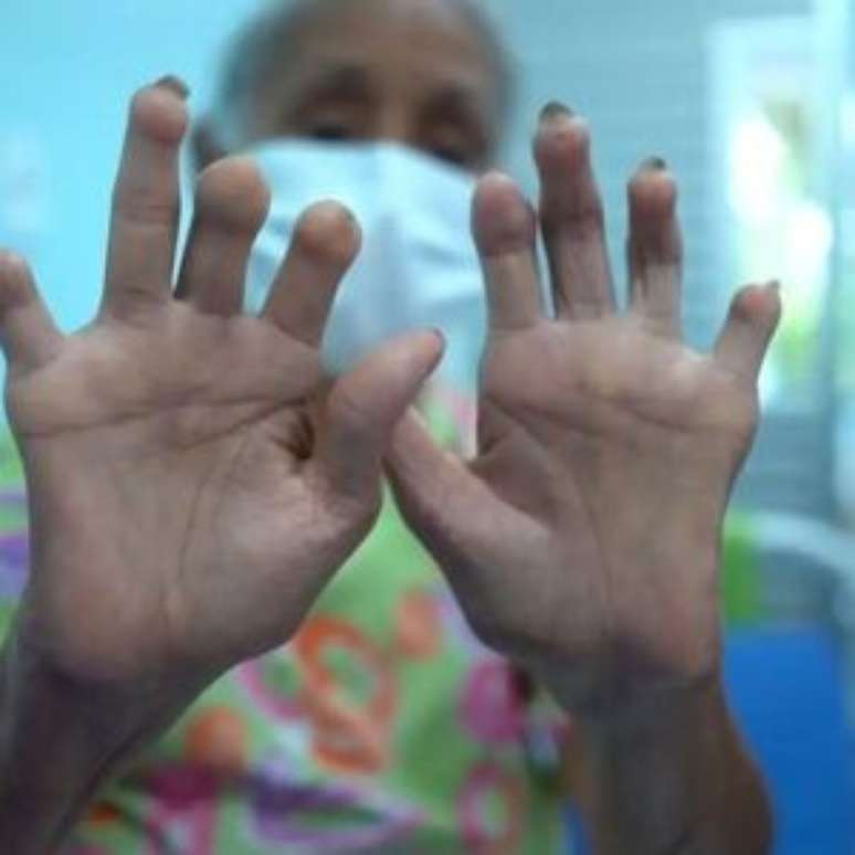 The children of the victims of leprosy are entitled to compensation, confirms StF