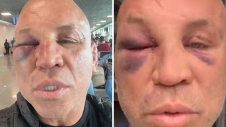 Wanderlei Silva revela que vai entrar na Justiça após sofrer agressões durante confusão / Reprodução: Instagram