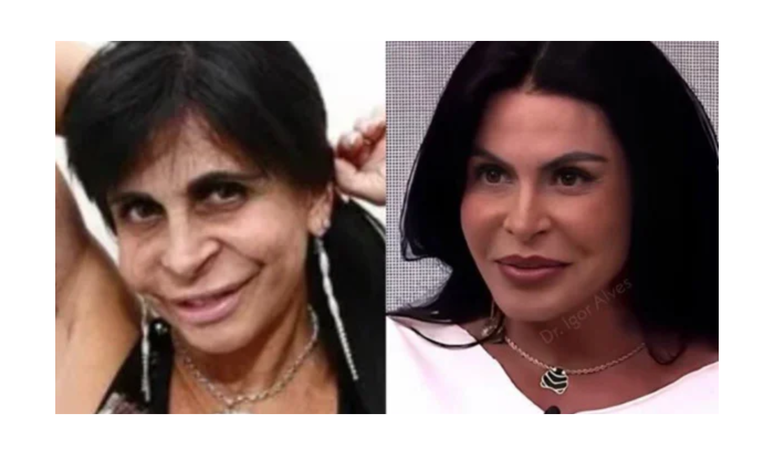 Before and after the “new face” of Gretchen viralizes criticisms of women: “repressed and frustrated”