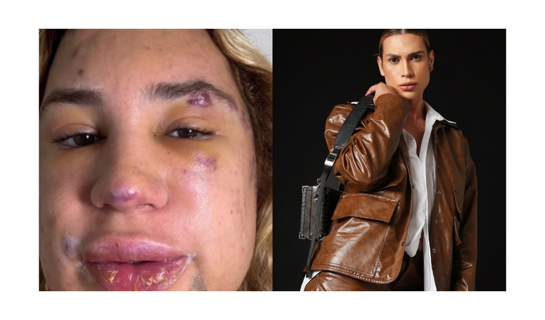 Influencer Junior Dutra dies after the complications of the “Fox Eyes” aesthetic procedure, aesthetic trend that promises to look for