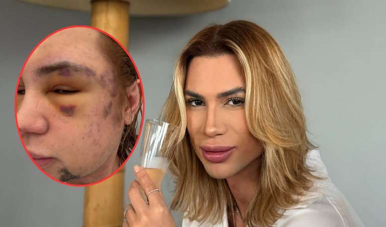 Who was Junior Dutra? Influencer who died after a dear aesthetic procedure of the famous dentist reported for fraud: “Escapio vene”
