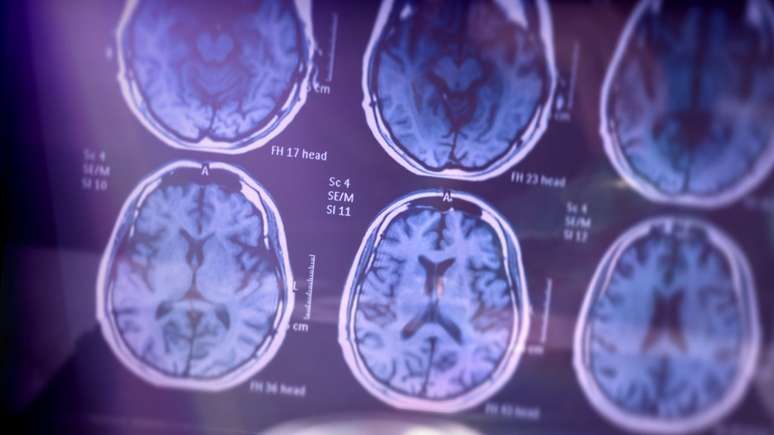 Alzheimer can influence the brain from the age of 20, says the study
