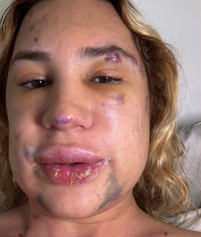 Influenciador morreu ap&oacute;s infec&ccedil;&atilde;o desencadeada por procedimento est&eacute;tico 