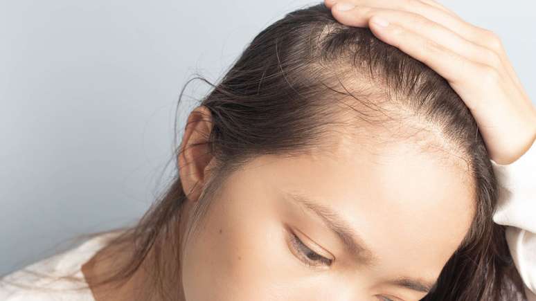 A calv&iacute;cie feminina &eacute; uma condi&ccedil;&atilde;o considerada rara