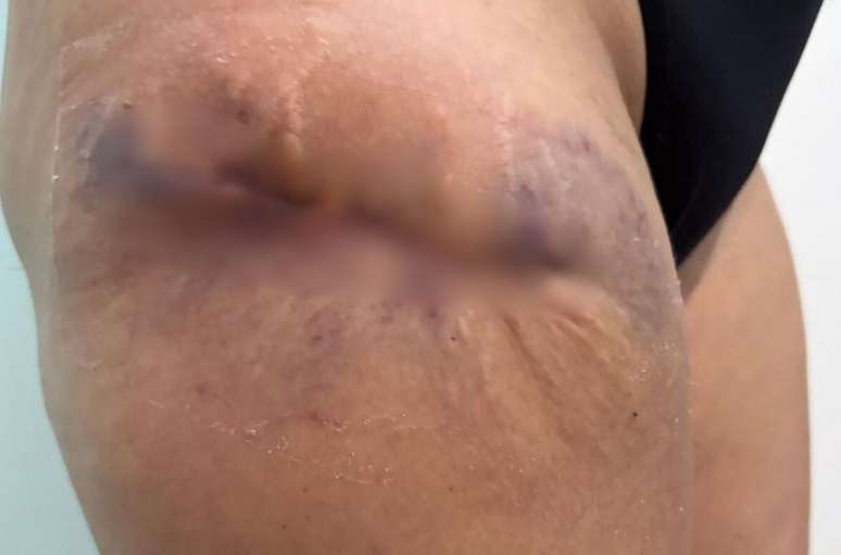 Modelo teve necrose nos glúteos e pernas após passar por procedimento estético