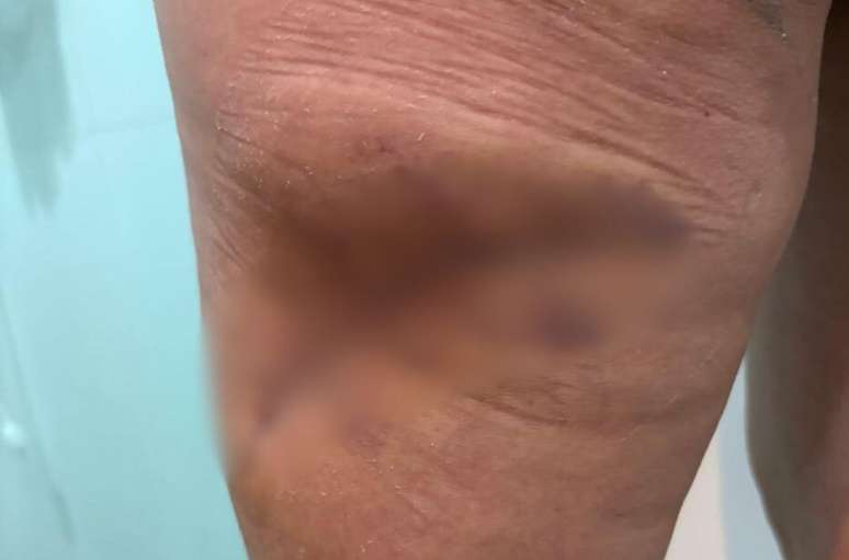 Karim Kamada precisou passar por duas cirurgias após procedimento