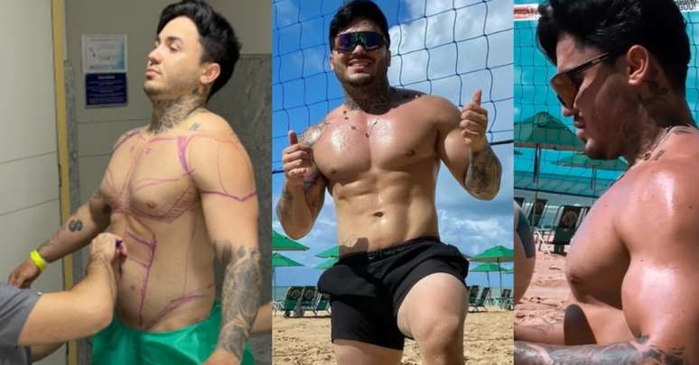 O cantor na marcação da lipoescultura e, após o período de recuperação, exibindo o peitoral sem ginecomastia e a barriga esculpida