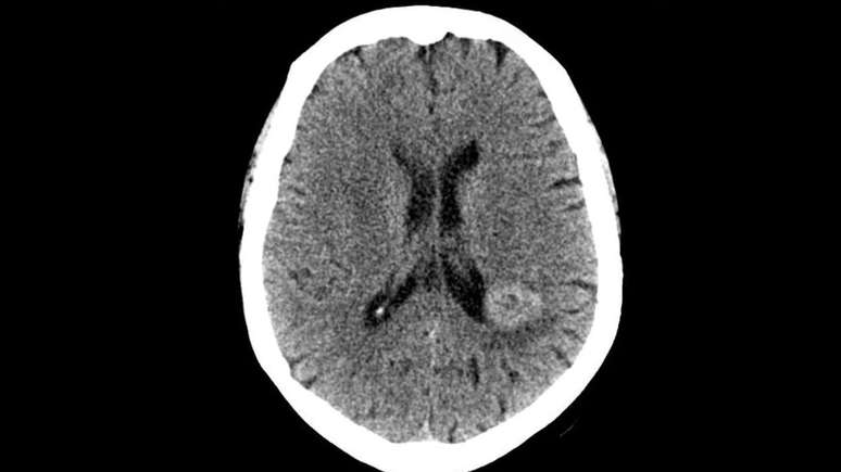 Inexplicable voices saved a woman who had a tumor on her head; understand