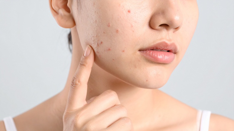 Pimples can indicate health problems; understand Pimples can indicate health problems; understand